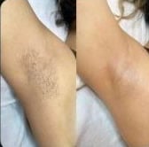 Axilas antes e depois