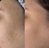 Pele do rosto antes e depois do tratamento