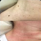 Remoção de sinais, antes e depois